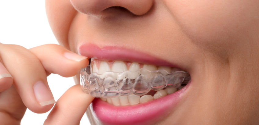 invisalign